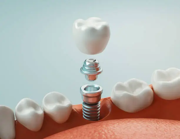 İmplant uygulaması Nedir ve Nasıl Yapılır?